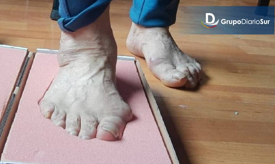 Más de 50 personas diabéticas de Chiloé recibirán calzado ortopédico