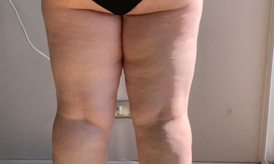 ¿Qué es el Lipedema? Responde estas 10 preguntas y sabrás si eres portadora de esta desconocida enfermedad